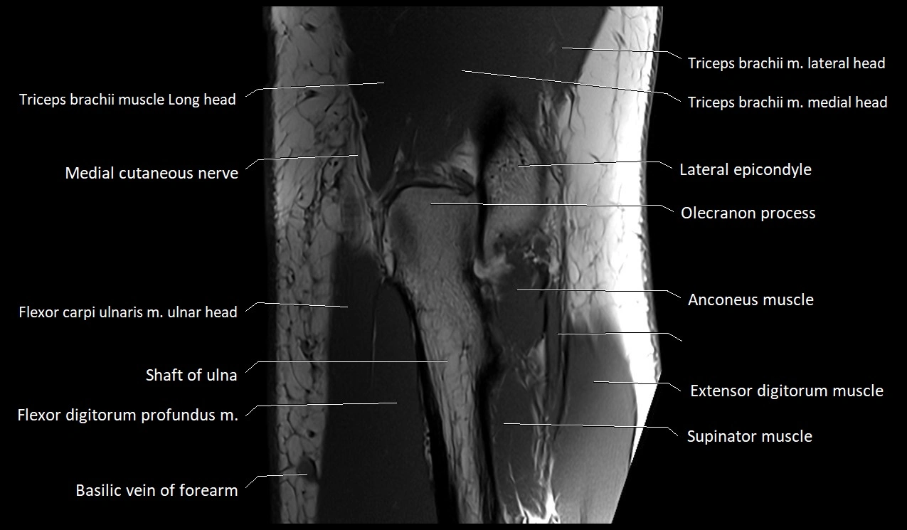 Elbow coronal anatomy image  cross sectional 3T MRI image 25.webp